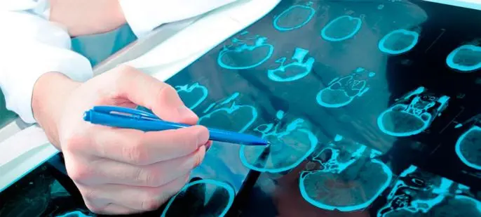 enfermedades neurologicas