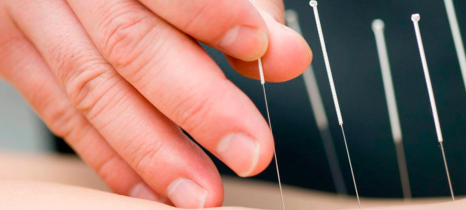 que es la acupuntura