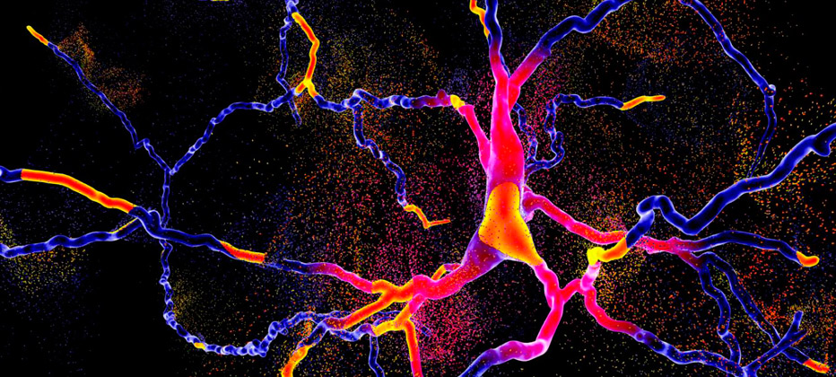 enfermedad de huntington causas