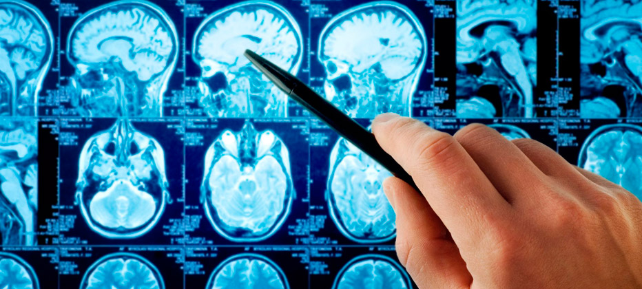 test alzheimer 10 preguntas