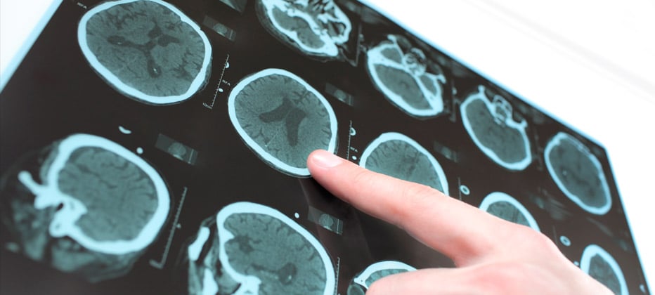 naturliche behandlungsmetho e epilepsie