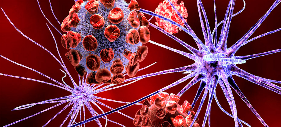 clases de esclerosis multiple