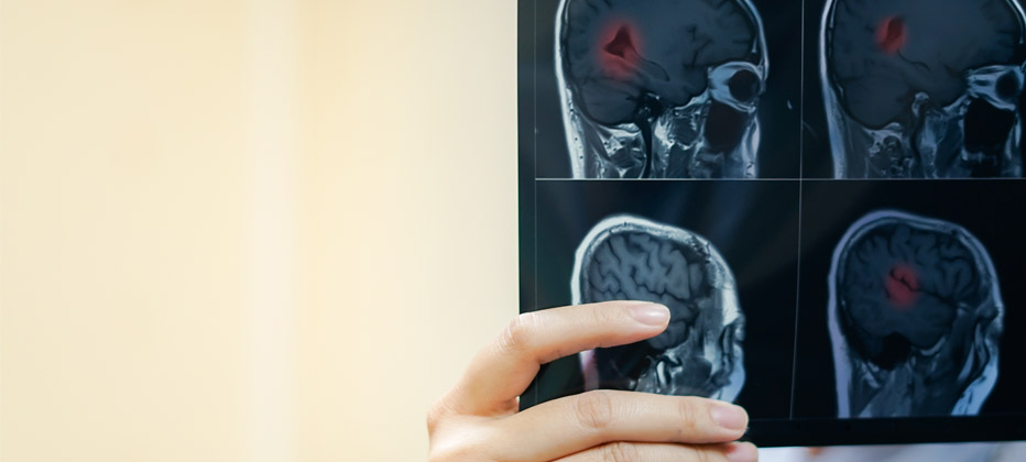 como se diagnostica la esclerosis multiple