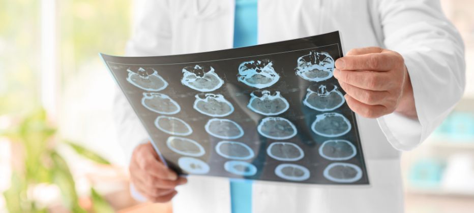 se puede tener parkinson y alzheimer a la vez